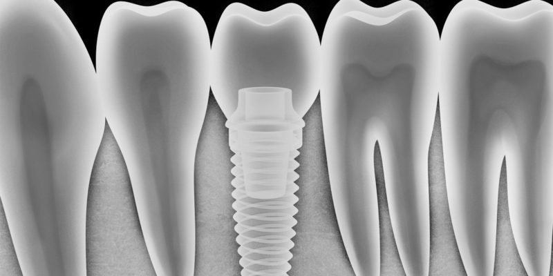 Tooth human implant x-ray (done in 3d, graphics)